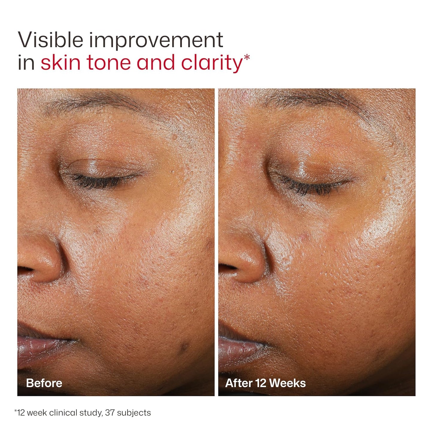 EltaMD UV Clear Facial Sunscreen SPF 46 — Oil-Free Zinc Oxide Formula, Dermatologist Recommended