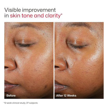 EltaMD UV Clear Facial Sunscreen SPF 46 — Oil-Free Zinc Oxide Formula, Dermatologist Recommended